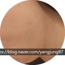 방배 성형외과 샘킴비너스 다녀온 후기 비너스달걀주사 두턱주사 같이 맞아봤어요