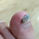 길*균 | 일본 발톱무좀 패치 곰팡이균 뿌리 뽑는 효과 에센스 후기