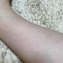 용해반점 | 다리에 붉은반점 모공각화증 로션 추천 및 솔직후기