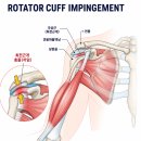 어깨통증이 반복된다면? 견갑하근 Trigger Point를 확인하세요. 이미지