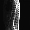 T-L spine of my mother 이미지