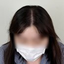 강남탈모 [더리움] 강남두피문신, 여성 정수리 탈모 커버