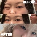 서울이왕병원 | [부산 서면] 무쌍 절개 눈매교정 8개월차 내돈내산 찐후기 낋여옴. [병원 알아보기편]
