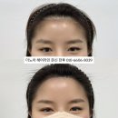 미용재료은복사 | 중랑구 상봉 반영구 헤어라인문신 가격과 1년 후기 어떻게 변했을까? (ft.유지력)