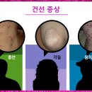 누가한의원 네이버블로그