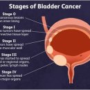 Bladder cancer 방광암 이미지