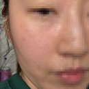금침한의원 | 의정부 노원 한의원 기미 제거 치료 레이저 약침 금침 통증 애브넘 잡티 노원기미치료 후기