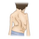 모르키오 증후군(Morquio syndrome ,Mucopolysaccharidosis IV형)유전질환 이란? 이미지