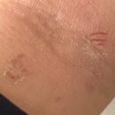 동의생한의원 | 탈스 8개월차 아토피 개선중 + 보습제 추천(광고아님 광고면 블로그삭제함)
