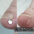 내성발톱 문제성발톱 Before After 전문 발관리샵이 특별한이유 #에이풋케어 이미지