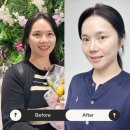 아이랑한의원 | 강남 다이어트 한의원 추천, 한약 &amp; 아○로웨이브 1차 후기 – 출산 후 살, 이번엔 진짜 빼본다!