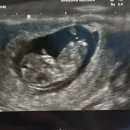 제인산부인과의원 | 임신 초기 매주 초음파 괜찮을까 임신 10주차 서브병원 방문