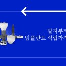 평내호평역치과 발치부터 임플란트 식립까지