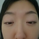 디옵터 | -9디옵터 초고도근시의 일반 라섹 후기: 2일간의 고통