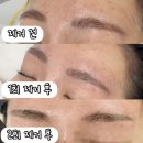 영등포 붉은 눈썹문신제거 가드니스뷰티 2회차 관리법
