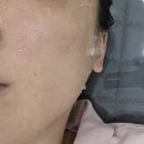 제이메디컬 | 광주 플라즈마 모공관리 피지제거 제이샵뷰티 1회 효과 대박