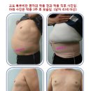 엔비코르셋