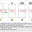 허리디스크란?? 이미지