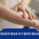 대상포진 초기증상 ＜예방,감염,치료＞ 대상포진 예방 좋은음식 이미지