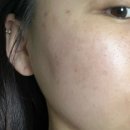 주미요 | 산본여드름관리 주미에스테틱 악건성 여드름피부 케어 솔직후기