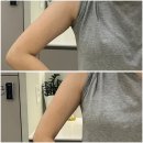 바노바기피부과의원 | 창원피부과 바노바기의원 바디핏주사 팔뚝 얇아지기