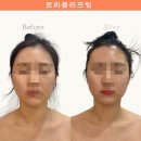 수성구피부관리 웨딩관리 (얼굴관리 등관리 목신경) 라베니 에스테틱 솔직후기