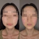 오늘의마이핏 | 연신내 윤곽관리 추천, 마이핏에스테틱 인비덤맥스 1회만으로 효과있었던 신부관리 받은 솔직후기