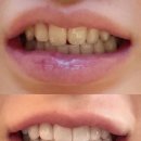 플래티 | 여러분.. 저 했어요!! 드디어 플래티네이트 했어요 (교정 이후 라미네이트 고민 후기)