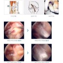 전방십자인대파열 증상에 따른 치료 잘하는 방법 이미지