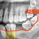 샤인이치과의원 네이버블로그