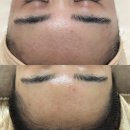 여드름 관리 맞춤 피부관리 후기, 미앤미스킨앤바디 이지다 양재점