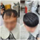 부산 탈모 전문 미용실 히든헤어 : 시술 후기 &amp; 두피 건강 관리법