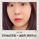 쏘인뷰티 | 수원 인계동 씨네파크 티타늄리프팅 후기 통증 없는 슬림핏윤곽주사로 이중턱 정리