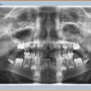 7세(만6세) 사진상 충치, 과잉치 문의드립니다! 이미지