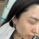 전등약국 | 분당 편평사마귀 제거 내돈내산 후기 듀오덤 X (feat.미금 편사제거 성지 1-2주차 후기)