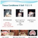 P.L(피엘) 치과기공소 | 티슈컨디셔너/소프트리라인 Tissue Conditioner Soft Liner 아크릴레진/템포라리/덴쳐용