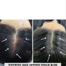 그로우모모 두피 탈모 케어센터 네이버블로그