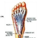 충격으로 인한 족저근막염 이미지