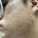 현승한의원 | 강남여드름치료(신사역) 성인여드름 한달치료 리얼후기