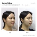 르수플