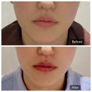 앙드 - 용산구 한남대로42길 12 | 강남,청담-에스테틱 (더 앙드)에서 알테온 레이저리프팅 받고 깜짝 놀란 솔직 후기