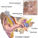 인공와우 초보자(?) 가이드 이미지