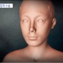 구강암 수술과정 이미지