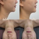 동광길 | 에쁘제이뷰티 셀린비 제로 블랙 리프팅 솔루션 1:1 맞춤 순천윤곽 관리 솔직 후기 (MTS 대신 플라즈마)