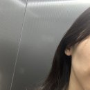 땅콩형 얼굴 볼패임 채우기 결절 없는 볼 스컬트라 1회차 후기 및 팔뚝 보톡스 디스포트 후기