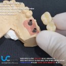 아카시아치과의원 | 어금니 임플란트 후기 염증정도 차이비교