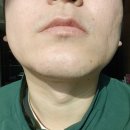 경희그린한의원 | 남자 수염제모! 생각보다 참을만했다. (feat.악센토N)