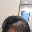 세솔메디컬의원 | 내돈내산 산후 탈모치료 후기 여성탈모 진짜후기