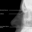 비골 골절[nasal bone fracture] 이미지