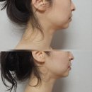 정관장삼계점 | 김해 웨딩관리 삼계 수에스테틱 턱쎄라 세라프팅 이중턱관리 집중관리 후기 (페이스라인 달라짐...